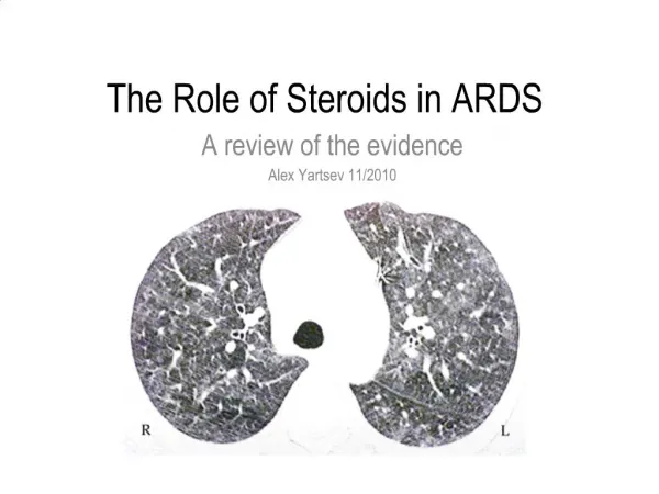 The Role of Steroids in ARDS