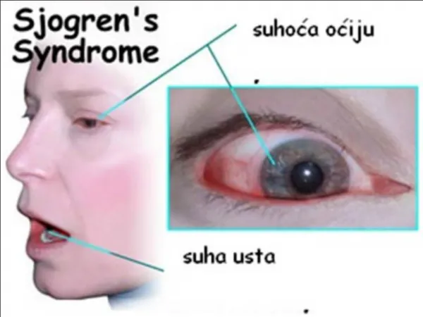 Sjogrens