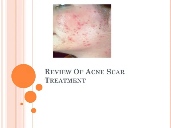 Review Of Acne Scar Treatment