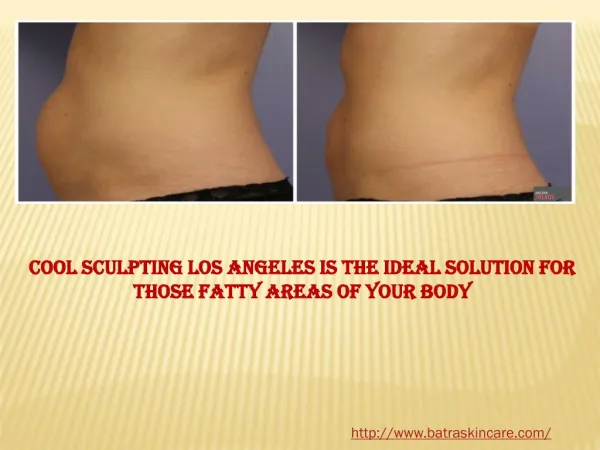 Cool Sculpting Los Angeles Is the Ideal Solution for those f