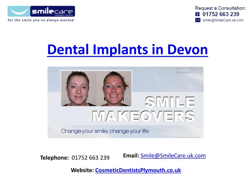 dental implants in devon