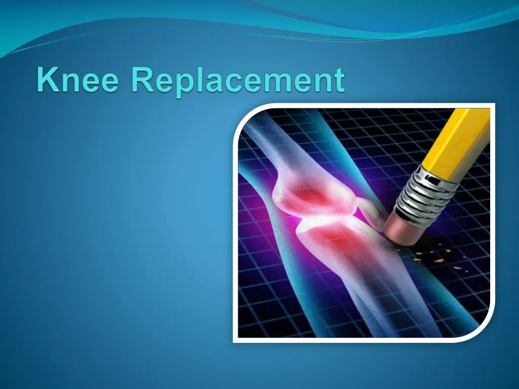 knee replacement