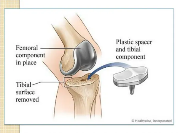 Affordable Knee Replacement Surgery India