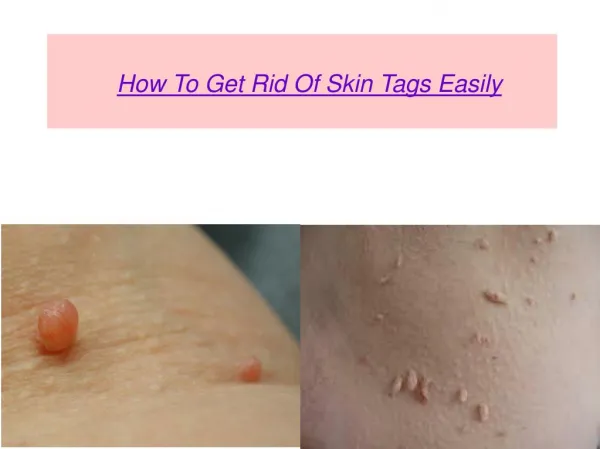 How To Get Rid Of Skin Tags Easily