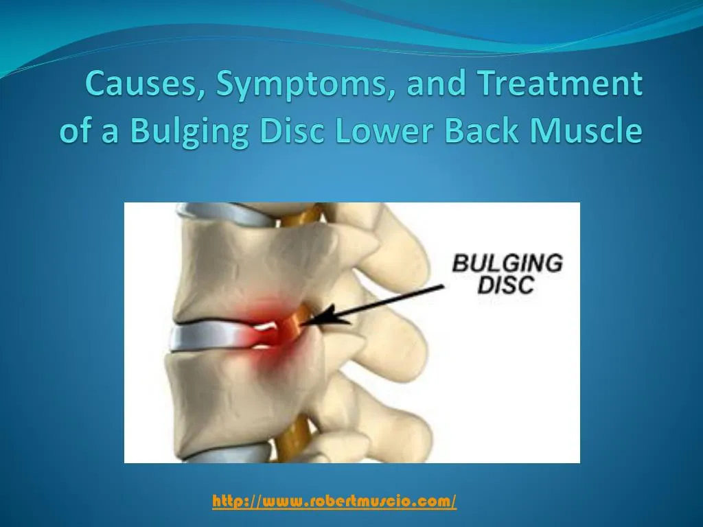 causes symptoms and treatment of a bulging disc lower back muscle