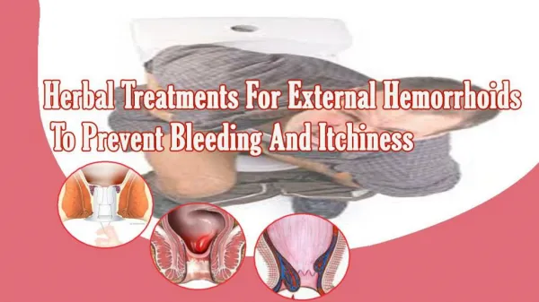 Herbal Treatments For External Hemorrhoids To Prevent