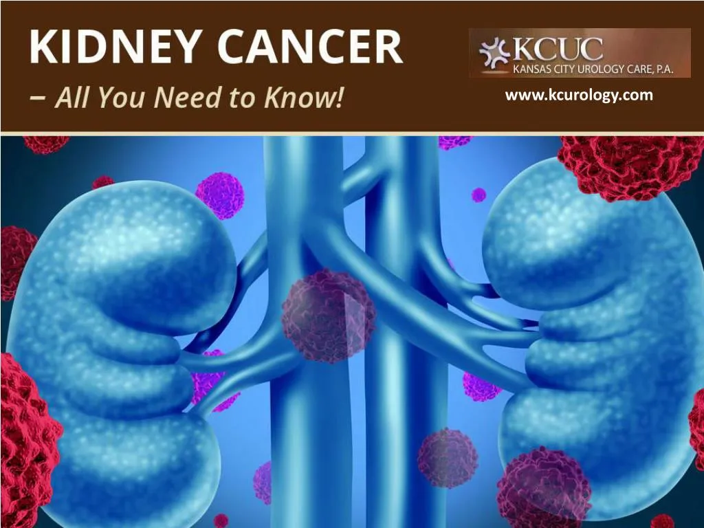 kidney cancer all you need to know