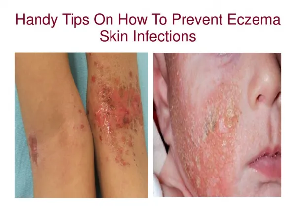 Handy Tips On How To Prevent Eczema Skin Infections