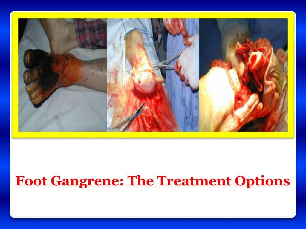 foot gangrene the treatment options