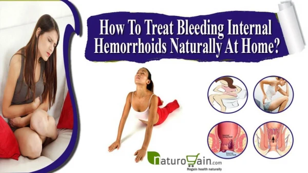 How To Treat Bleeding Internal Hemorrhoids Naturally At Home