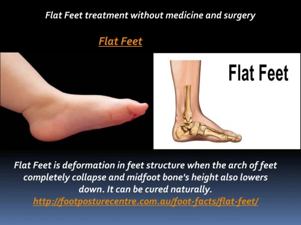 Flat Feet treatment without medicine and surgery