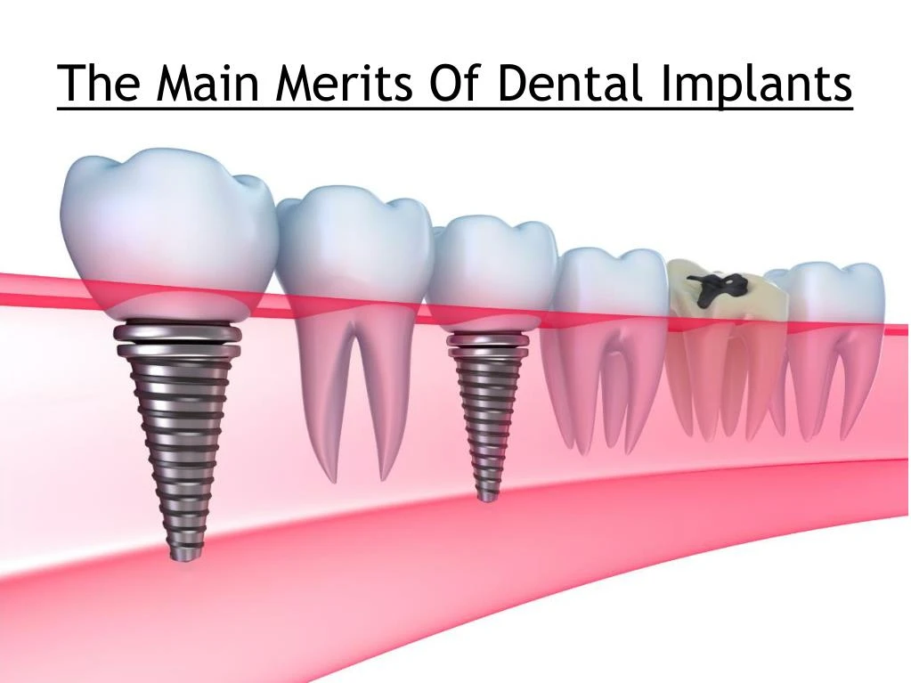 the main merits of dental implants