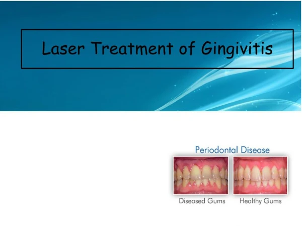 Laser Treatment of Gingivitis