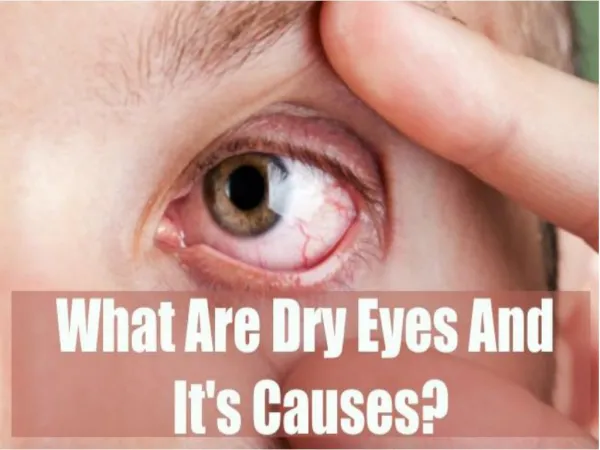 What are Dry eyes and it's causes?