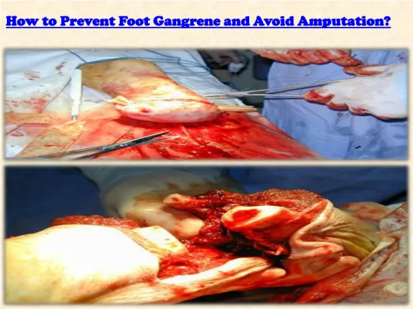 Prevent Foot Gangrene and Avoid Amputation