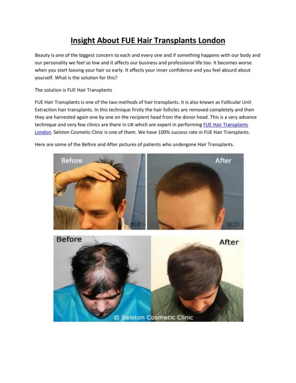 Insight About FUE Hair Transplants London