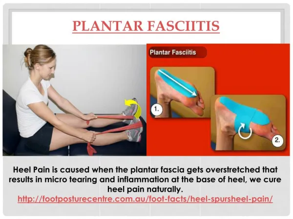 Plantar Fasciitis Heel Pain Natural Treatment
