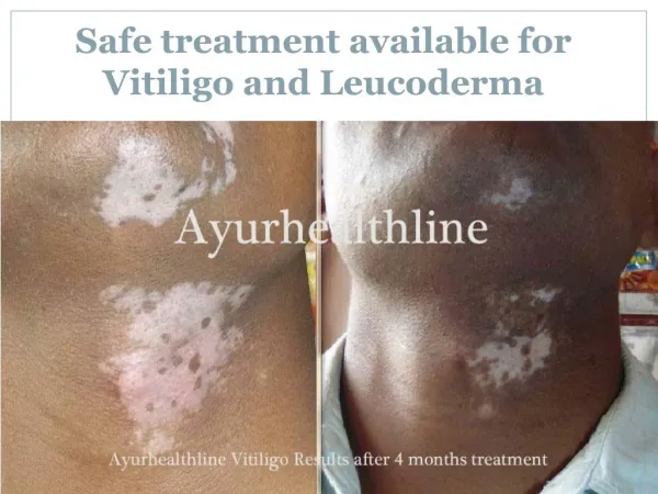 Safe treatment available for Vitiligo and Leucoderma