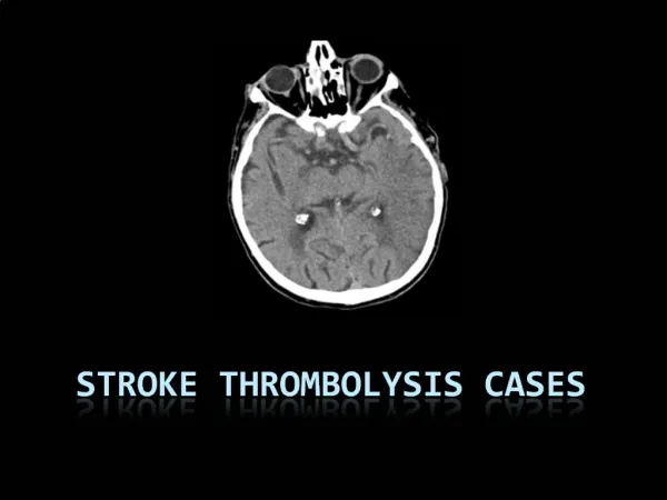 Stroke Thrombolysis Cases
