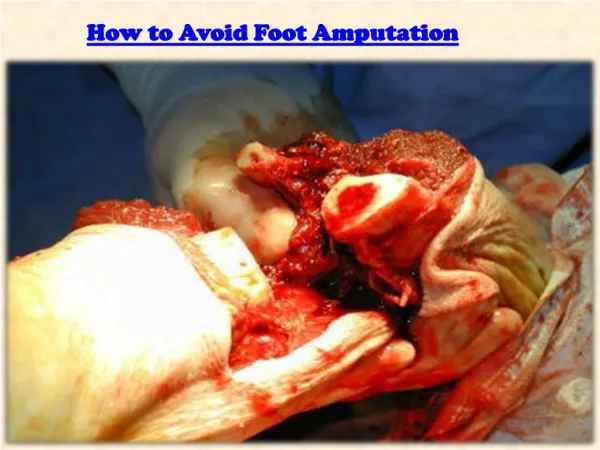 How to Avoid Foot Amputation