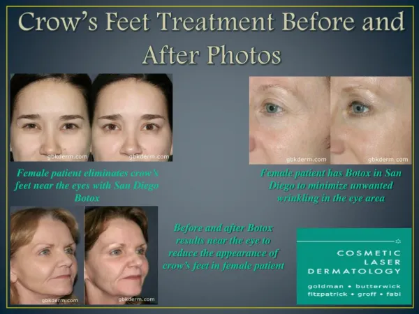 Before And After Botox San Diego