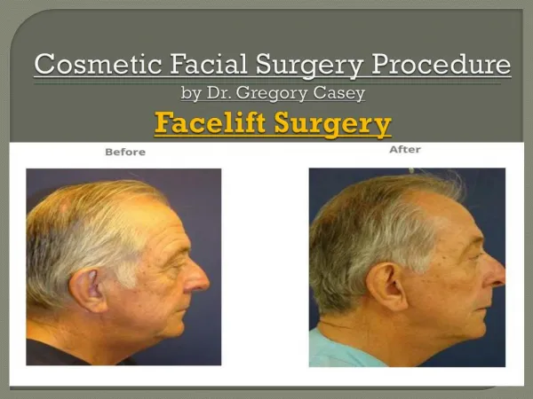 Facelift Surgery - Dr Gregory Casey