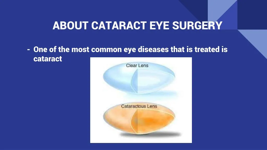 about cataract eye surgery
