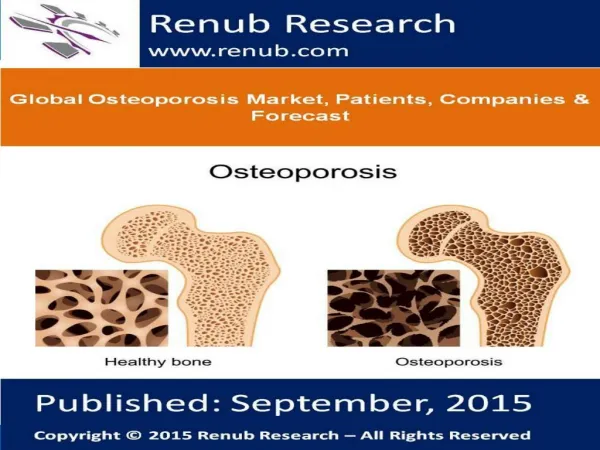 Global Osteoporosis Market, Patients, Companies & Forecast