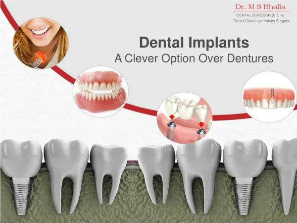 Dental Implants - A Clever Option Over Dentures
