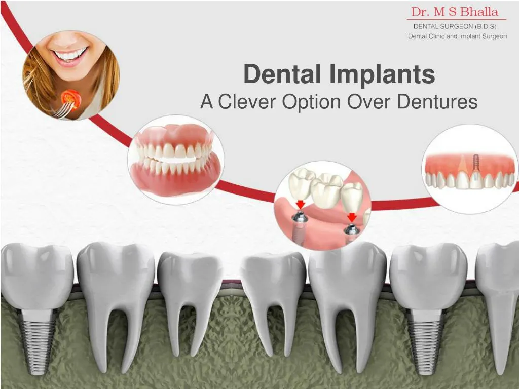 dental implants a clever option over dentures