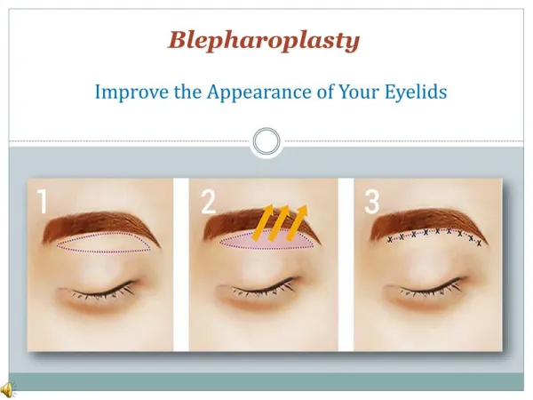 What is Eyelid Surgery Blepharoplasty