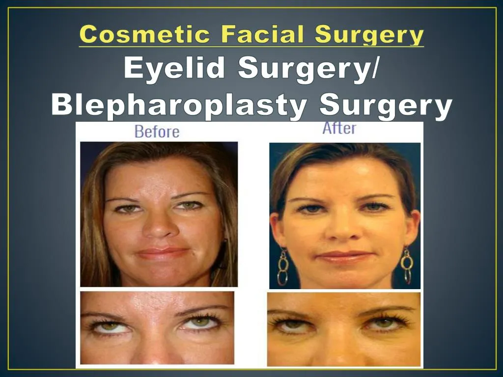 cosmetic facial surgery eyelid surgery blepharoplasty surgery