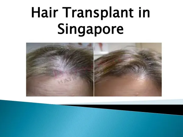 Hair transplant in Singapore