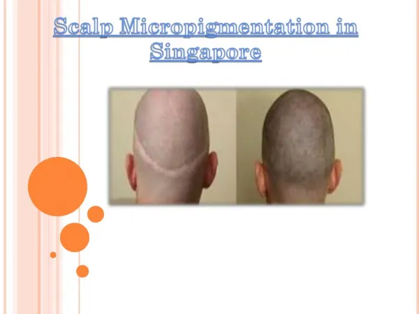 scalp micropigmentation Singapore