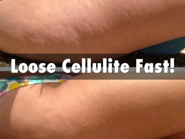 Cellulite - How to Get Rid of Cellulite