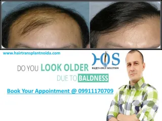 HOS Best Hair Transplant in Delhi