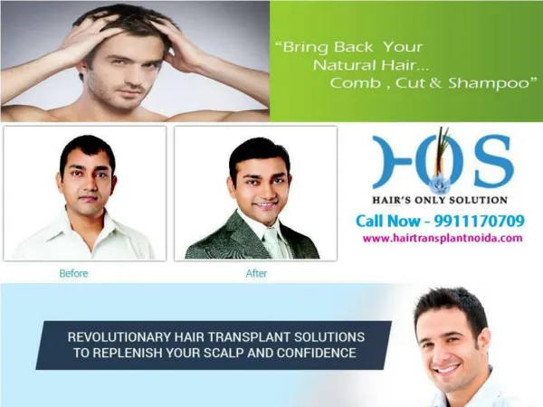 Permanent Hair Transplantation in Delhi