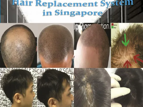 Hair Replacement System in Singapore