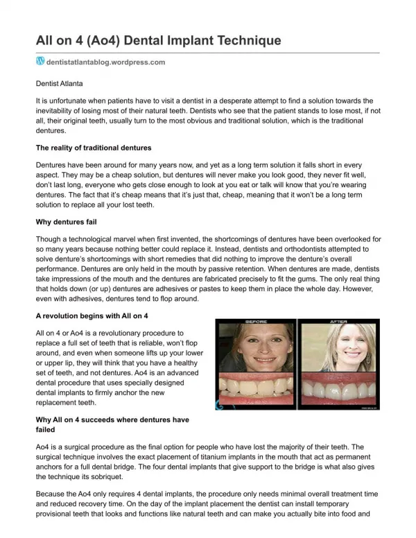 All on 4 (Ao4) Dental Implant Technique