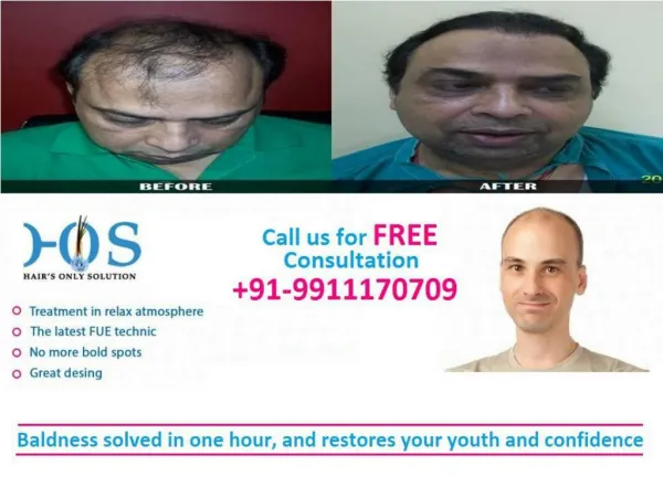 Pain Less Hair Transplantation in Delhi