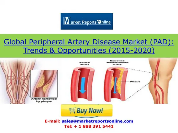Peripheral Artery Disease (PAD) Market Trends and 2020 Forecasts