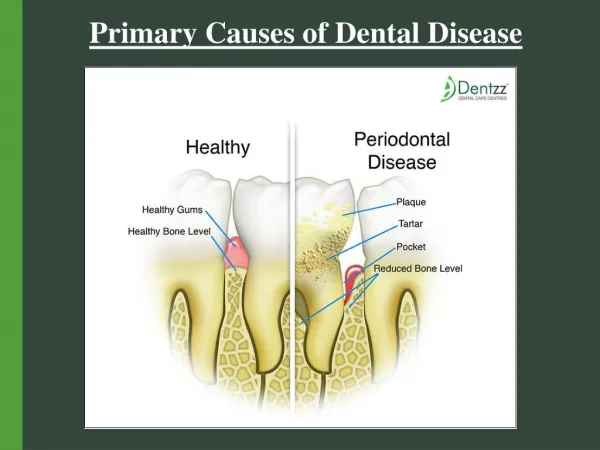 Primary Causes of Dental Disease