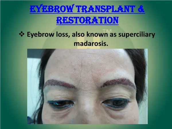 Eyebrow Transplant & Restoration | Eyebrow Hair Transplant