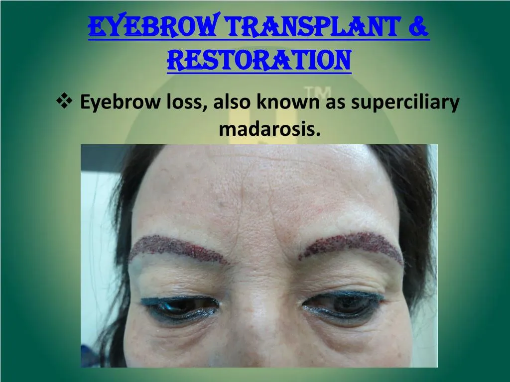 eyebrow transplant restoration