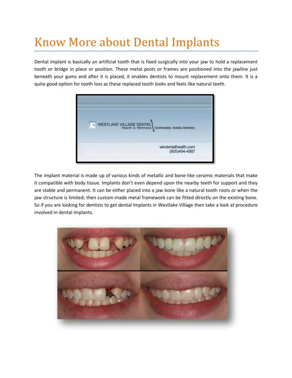 Know More about Dental Implants