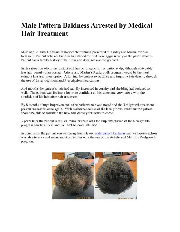 Male Pattern Baldness Arrested by Medical Hair Treatment
