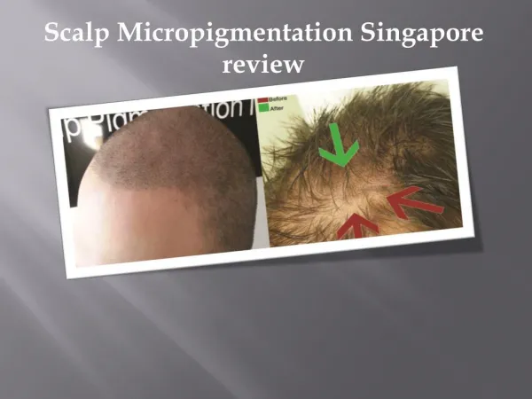 Scalp Micropigmentation Singapore review
