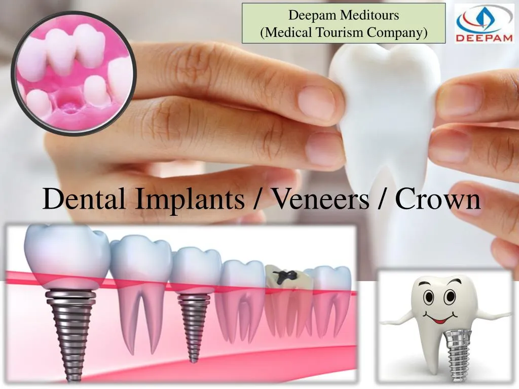 dental implants veneers crown