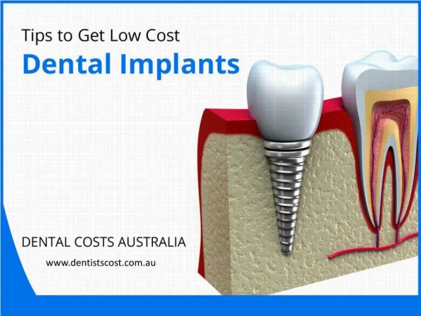 Expert Tips to Get Low Cost Dental Implants in Australia