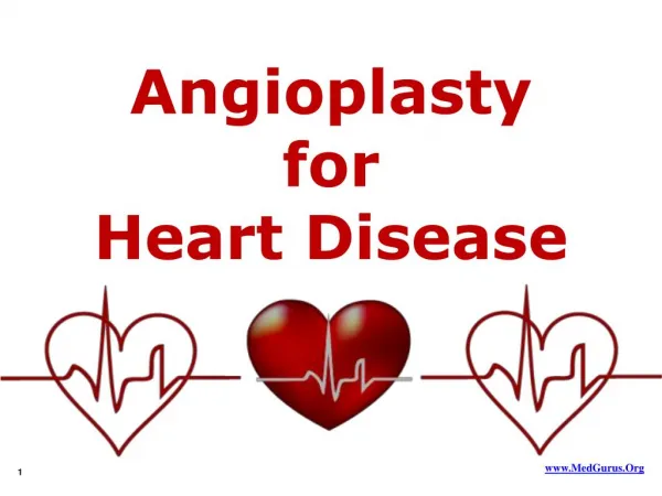 Facts on Angioplasty